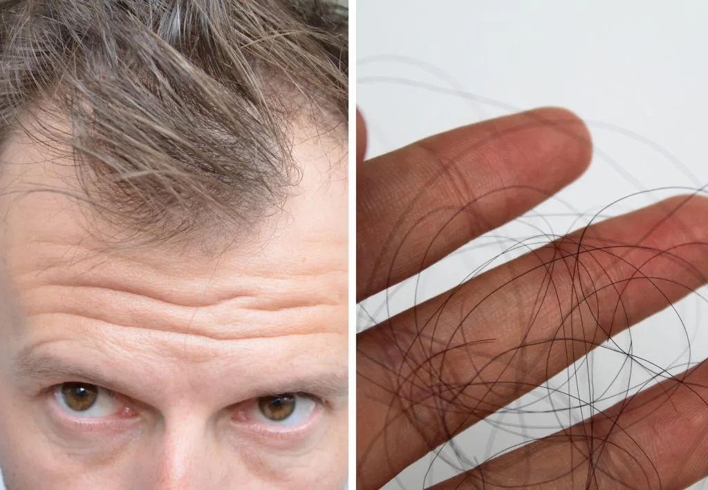 Sudden hair loss