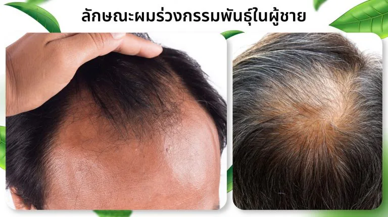 Male hereditary baldness
