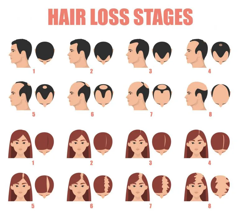 Patterns of hereditary hair loss