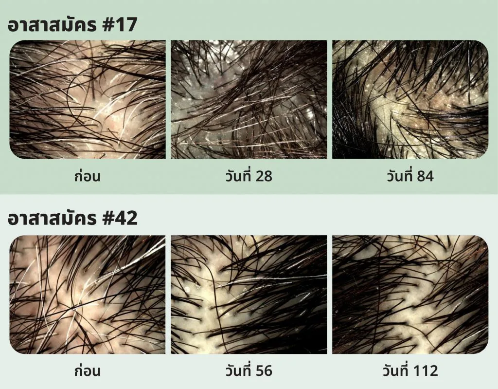 Densidyl reduces stress-induced grey hair