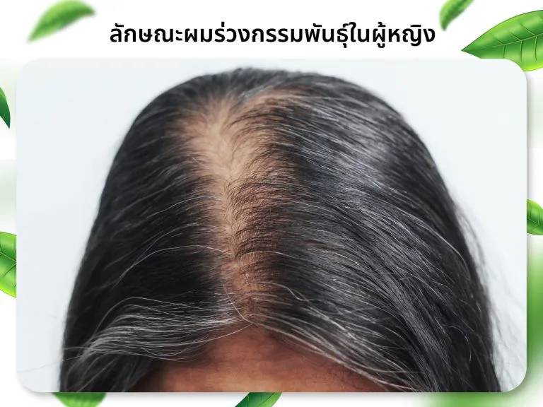 Female hereditary hair loss