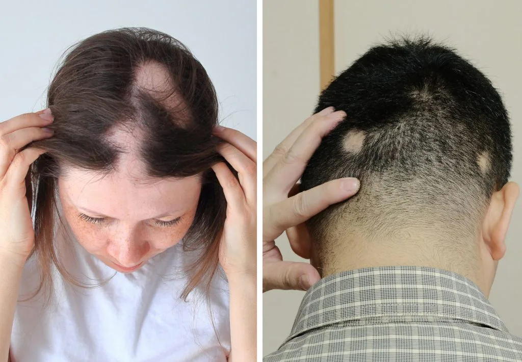Patchy hair loss (alopecia areata)