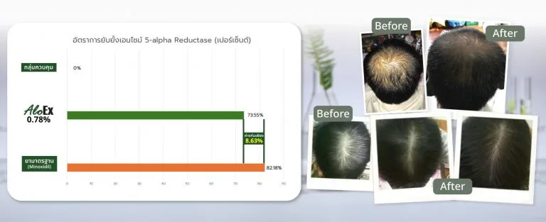 AloEx vs. Finasteride